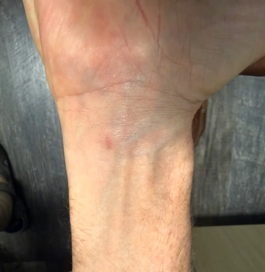 A real wrist after ultrasound-guided carpal tunnel release, showing the tiny healed opening