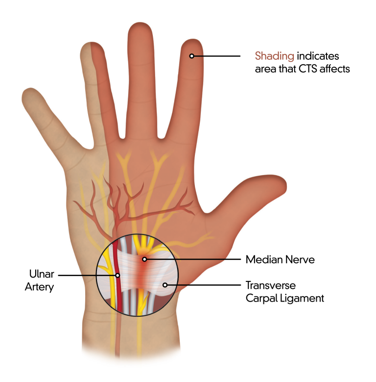 Anatomy of carpal tunnel syndrome — the median nerve and transverse carpal ligament at the wrist