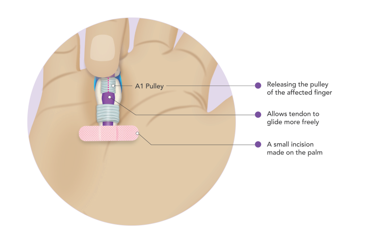 Trigger finger release — the A1 pulley at the base of the finger is released so the tendon glides freely
