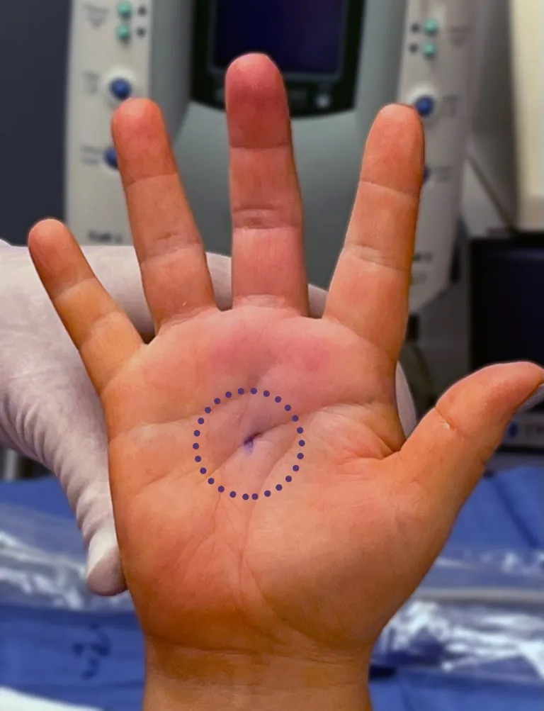 A real patient hand after trigger finger release showing the tiny opening in the palm